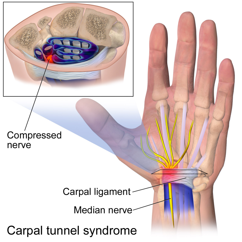 Anatomical illustration of the carpal tunnel showing the median nerve compressed beneath the transverse carpal ligament